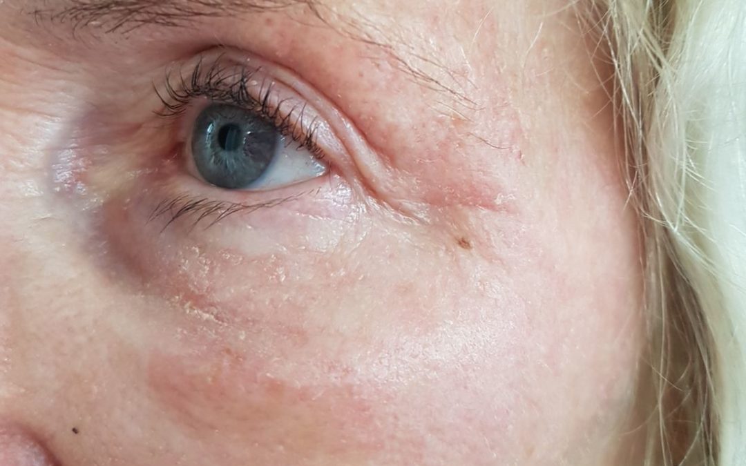 Fibroblasting – Skin Tightening for Wrinkles