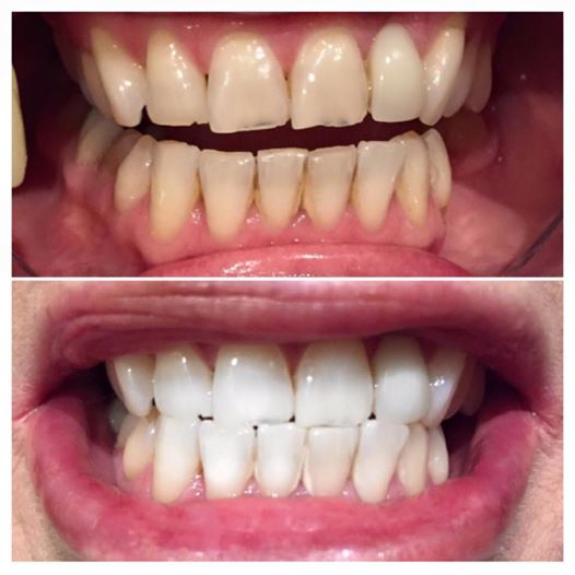 Teeth Whitening Teeth Whitening