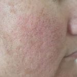 acne scarring after