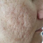 acne scarring before