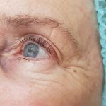 Crows feet before procedure