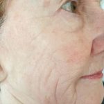 deep wrinkle after