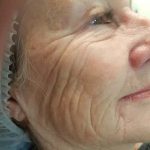 deep wrinkle before