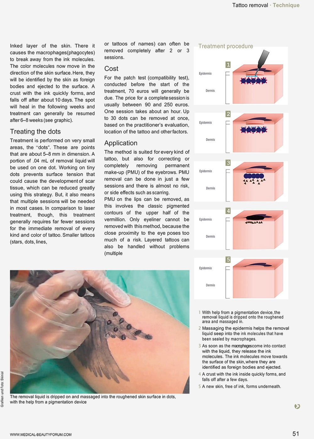Microsoft Word 50 Technik Tattooentferung ENGLISH