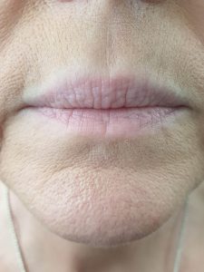 For The Love of Beauty Full Lip Tattoo Before