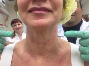 HIFU Neck 2 after