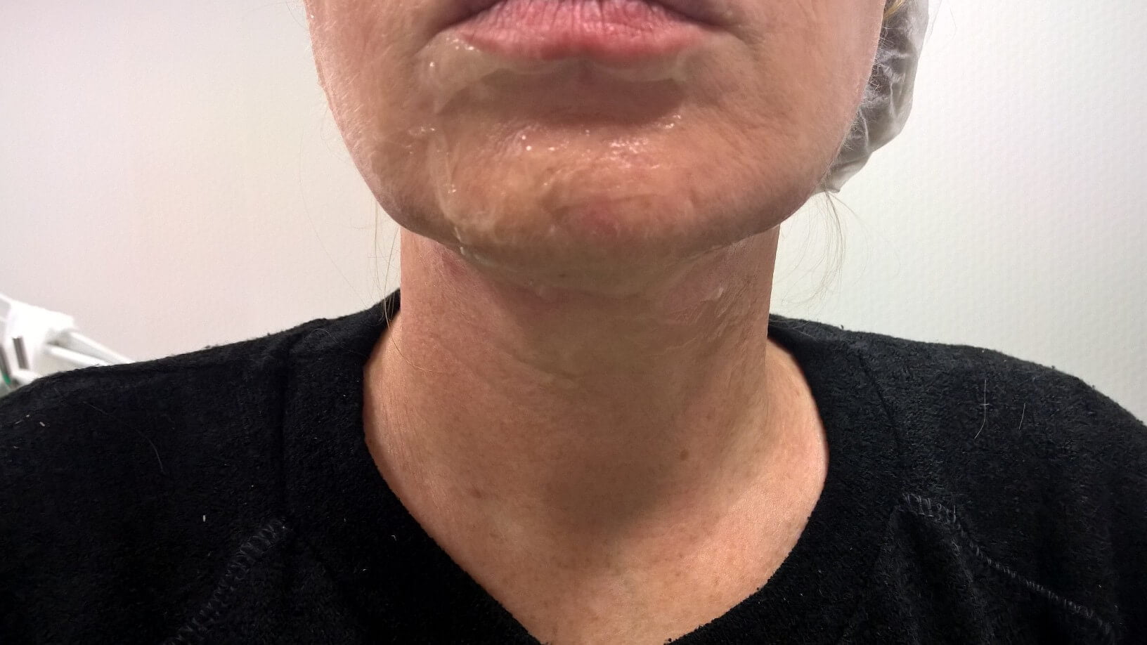 ForTheLoveofBeauty_HIFU_NeckChin-2after (1) HIFU Neck Chin after