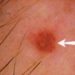Cherry Angioma Cherry Angioma image