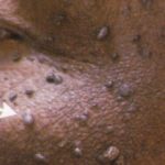 Fibroma image 2 Fibroma image 2