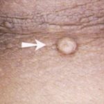 Flat Skin Tag Flat Skin Tag image