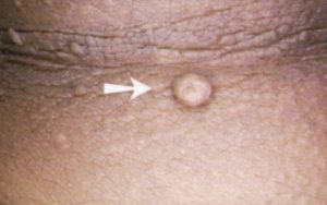 Flat Skin Tag image