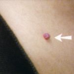 Raised Angioma Raised Angioma image