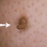 Skin Tag Stalk Skin Tag Stalk image