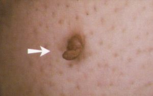 Skin Tag Stalk image