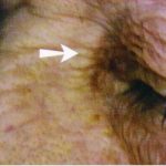 Cholesterol Deposit 2 Cholesterol Deposit 2 image