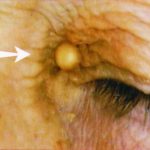 Cholesterol Deposit Cholesterol Deposit image