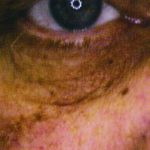 Skin Tag Eye Skin Tag Eye image 2