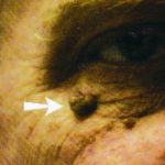 Skin Tag Eye 2 Skin Tag Eye image