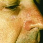 Vascular Nose Vascular Nose image