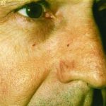 Vascular Nose 2 Vascular Nose image 2