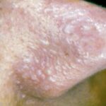 LP- Cholesterol Deposit Before - Telan