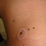 LP - Fibromas3 -Before