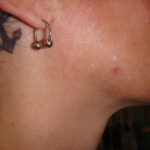 Spider Naevi Before