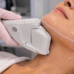 HIFU handpiece treating the jawline at For the Love of Beauty in Hornsby