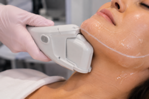 HIFU handpiece treating the jawline at For the Love of Beauty in Hornsby