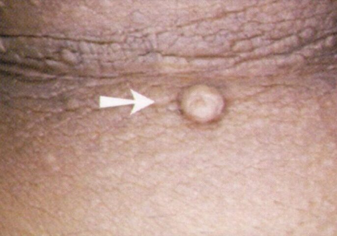 Flat Skin Tag image