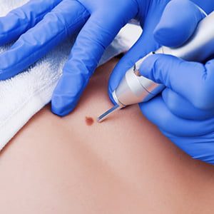 Cryotherapy Cryotherapy (Remove Warts, Cysts, Pigmentation & More)