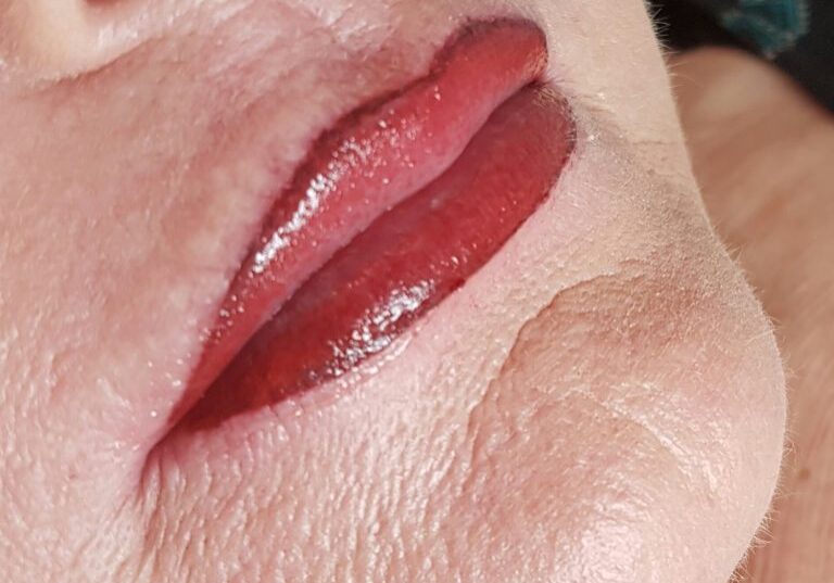 lip with filler