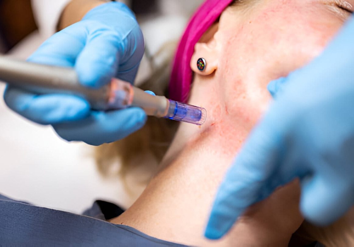 Understanding Collagen Induction Through Skin Needling -image (1) Understanding Collagen Induction Through Skin Needling -image (1)