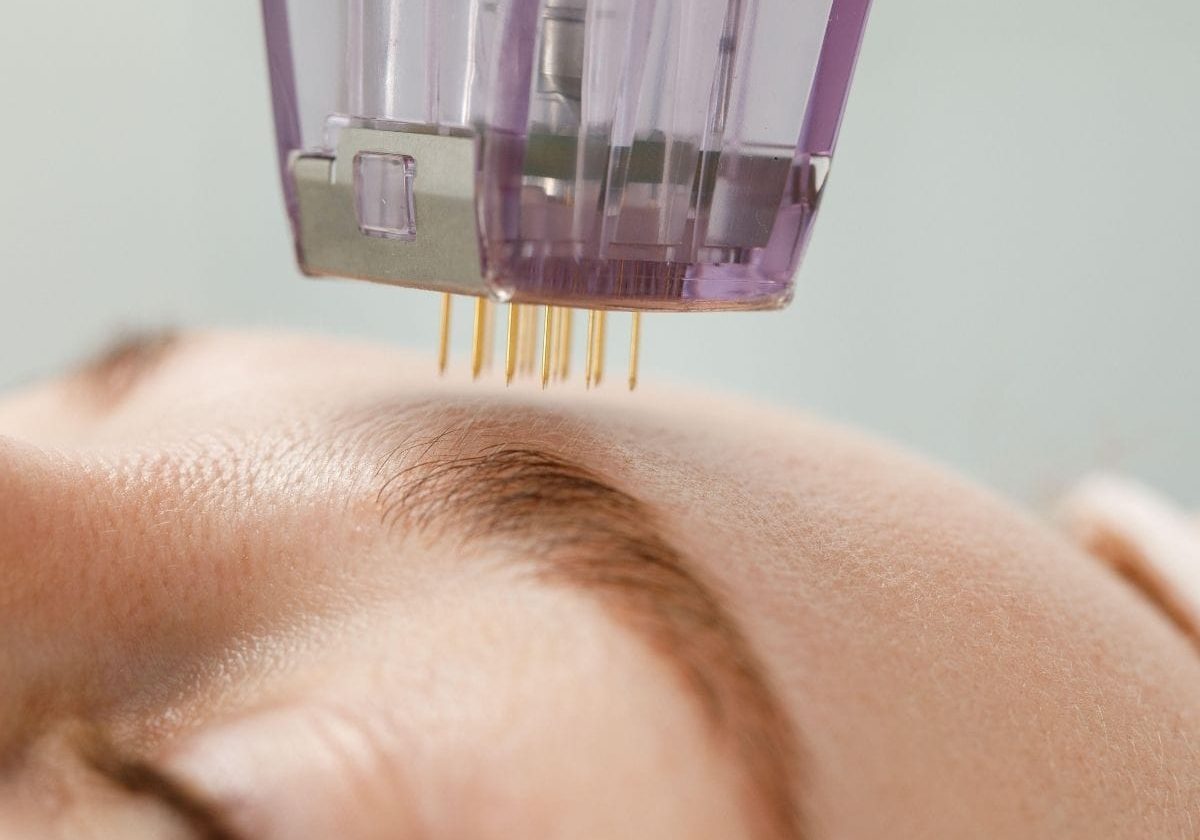 does-skin-needling-work-better-in-winter-or-summer-img (3) does-skin-needling-work-better-in-winter-or-summer-img (3)