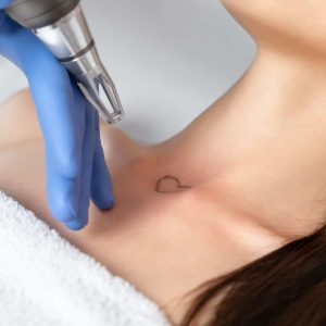 removal Cosmetic Tattoo and Removals 2