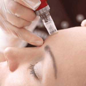 skinneedling Skin Needling (Mesotherapy)